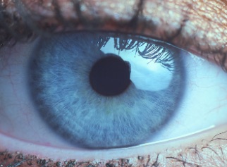 Iride linfatica: azzurro chiaro con fibrille ben visibili