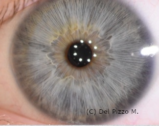 Sottotipo neurogeno: fibrille biancastre dal tragitto sinuoso