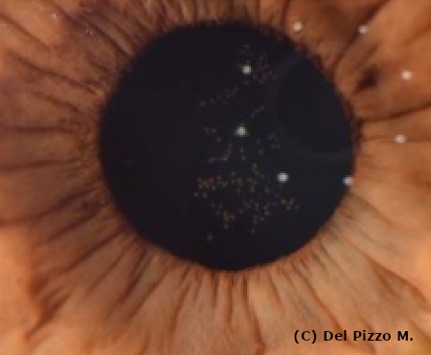 Via Lattea: minuscole macchie chiare diffuse sulla pupilla